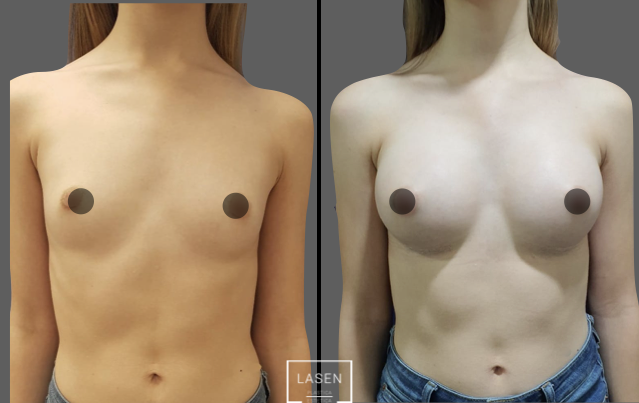 antes-y-despues-casos-mamoplastia-aumento-2-639x403-001-639x403-c-default