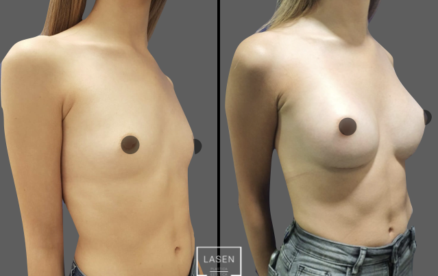antes-y-despues-casos-mamoplastia-aumento-2-639x403-002-639x403-c-default