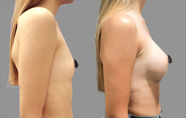 antes-y-despues-casos-mamoplastia-aumento-2-639x403-003-639x403-c-default